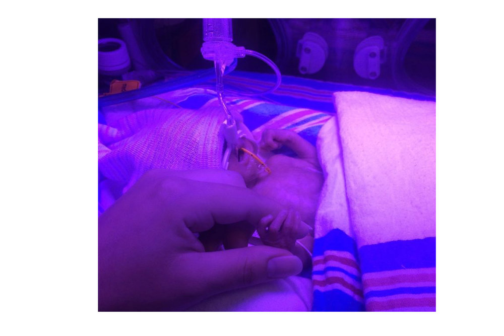 Premature baby when born at South Miami Baptist Hospital
